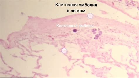 Опухолевые эмболы: определение и принцип действия