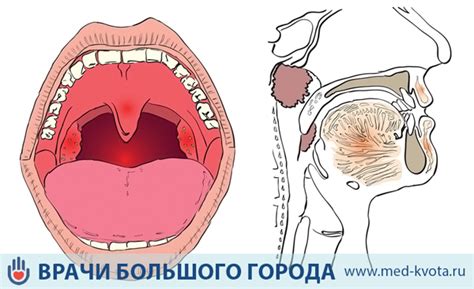 Ослабление голосовых связок из-за воспаления