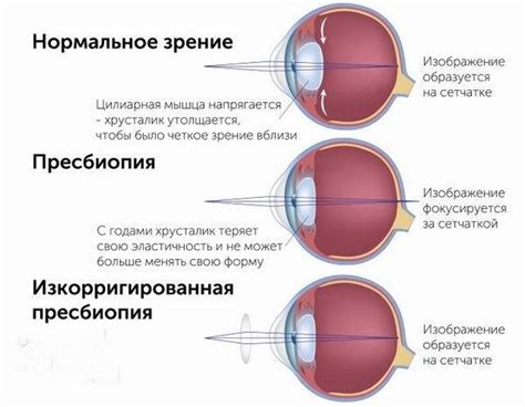 Осложнения, связанные с гиперметропией слабой степени правого глаза