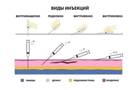 Основные виды инъекций