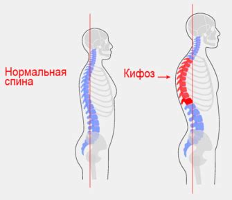 Основные причины перекоса позвоночника вправо