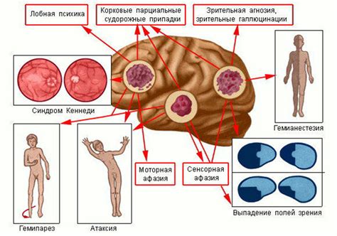 Основные причины появления эпи очагов в головном мозге