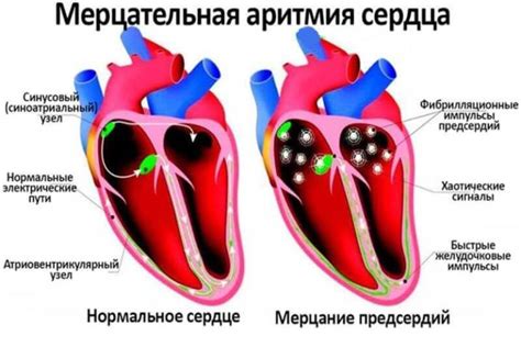 Основные симптомы аритмии