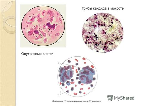 Основные симптомы и последствия черных волокон в мокроте