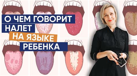 Основные симптомы налета на языке у ребенка