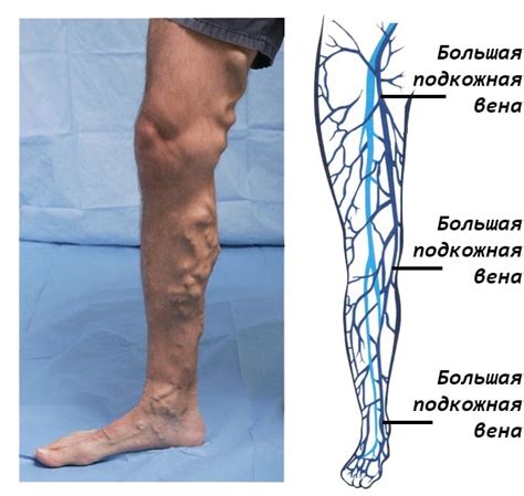 Основные симптомы несостоятельности перфорантных вен голени