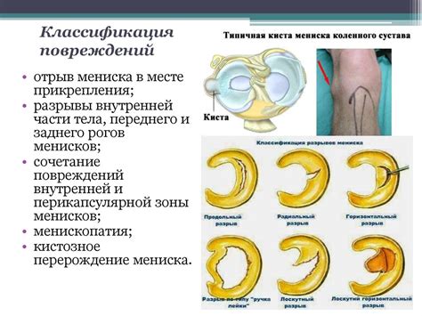 Основные симптомы повреждения мениска