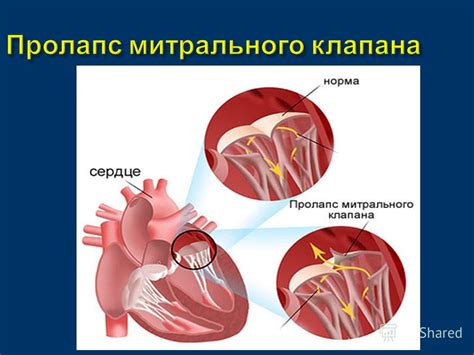 Основные симптомы пролапса митрального клапана