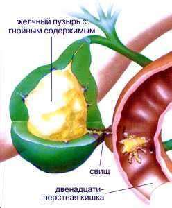 Основные симптомы эмпиемы желчного пузыря