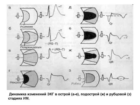 Особенности интерпретации динамических изменений ЭКГ