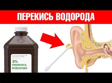 Осторожное использование перекиси водорода для очистки ушей от серы