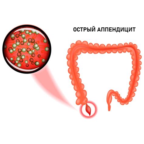 Острый аппендицит может вызывать спайки внизу живота слева