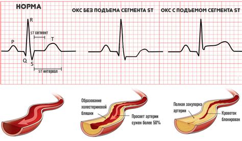 Острый коронарный синдром