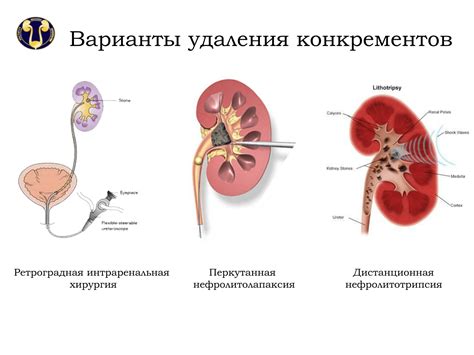 Отсев широконаправленных почек