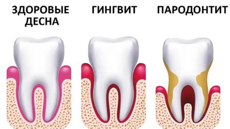 Пародонтит и пародонтоз