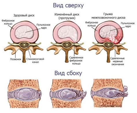 Патологии позвоночника и межпозвонковых дисков