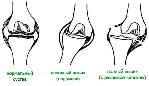 Первая помощь при вывихе колена