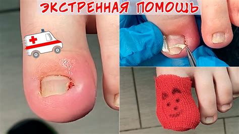 Первая помощь при оторванном ногте на ноге