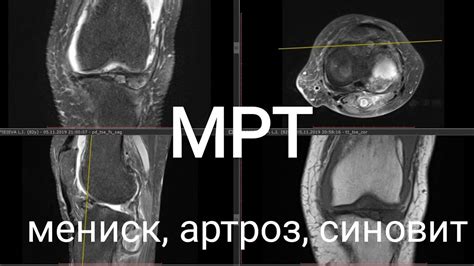 Первая помощь при повреждении мениска колена