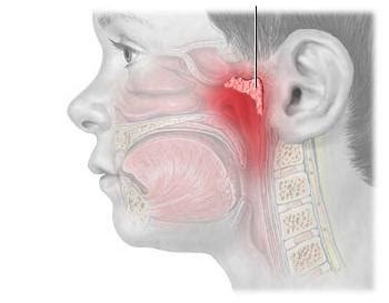 Первичные причины развития воспаления аденоидов