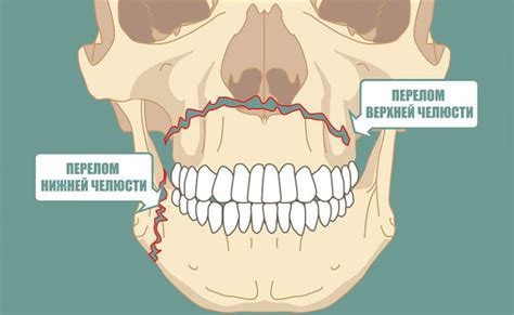 Переломы челюсти