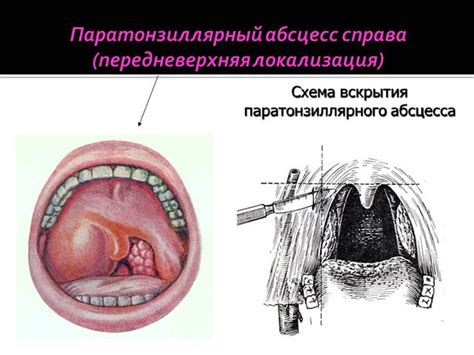 Питание после вскрытия паратонзиллярного абсцесса