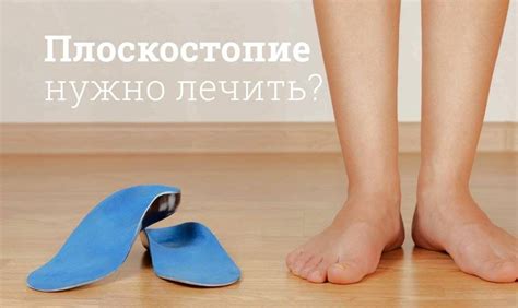 Плоскостопие: симптомы, причины и лечение