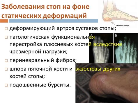 Плоскостопие и деформации стоп