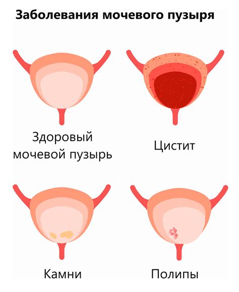 Полипы мочевыделительной системы