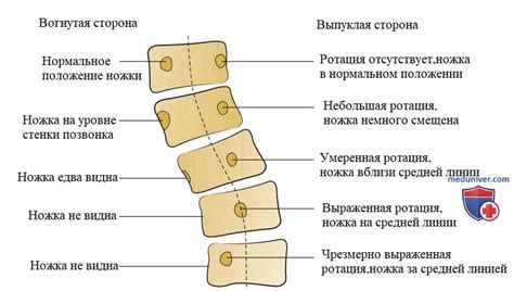 Помощь родителям при обнаружении искривления позвоночника у ребенка