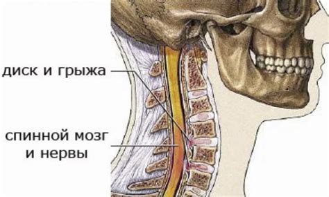 Последствия неверного лечения грыжи в шейном отделе