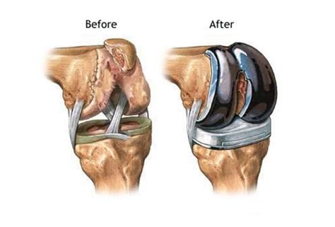 Последствия операций на коленном суставе