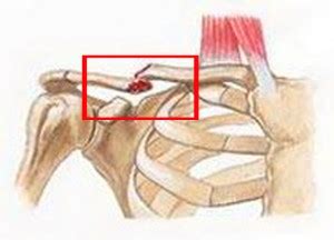 Последствия повреждений ключицы и их лечение