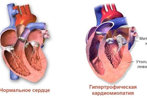 Последствия пролапса митрального клапана и их лечение