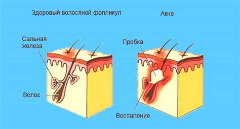 Появление глубоких болезненных прыщей