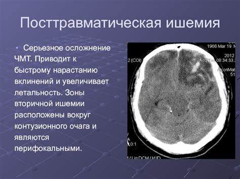 Предупреждение контузионного очага головного мозга