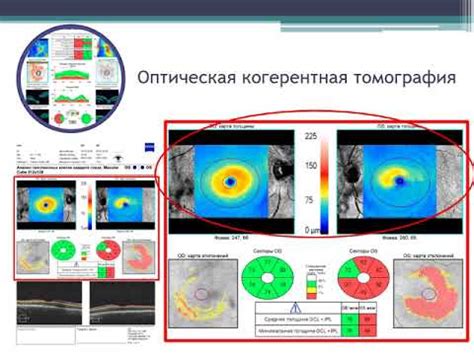 Преимущества ОКТ ДЗИ при выявлении глаукомы