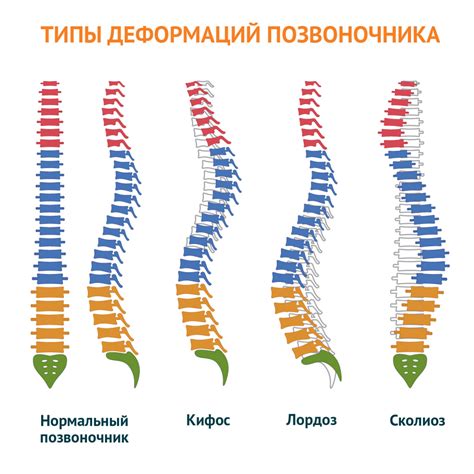 Признаки искривления позвоночника