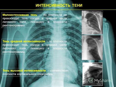 Примеры патологических состояний, при которых наблюдаются округлые тени на рентгенограмме легких