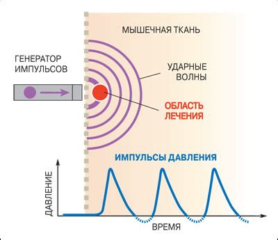 Принцип действия ударно-волновой терапии на сустав локтя