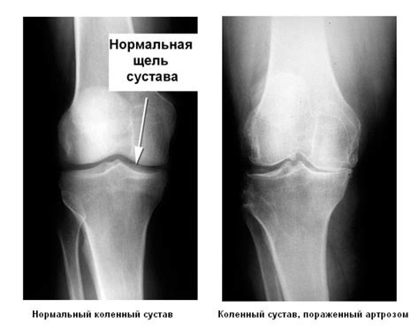 Причины внутреннего поражения коленного сустава