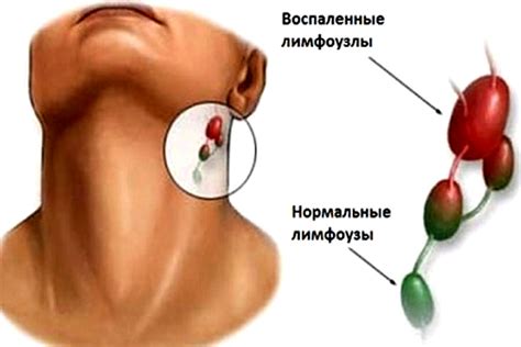 Причины возникновения бифуркационного лимфоузла