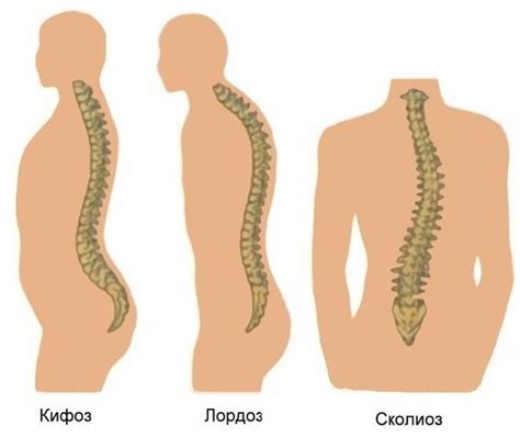 Причины возникновения искривления позвоночника