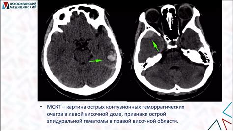 Причины возникновения контузионного очага