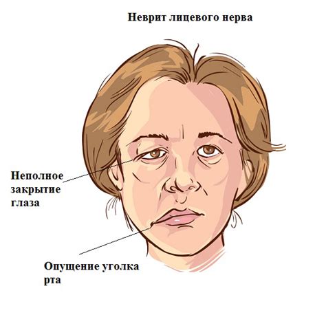 Причины возникновения неврита, невралгии и полинейропатии