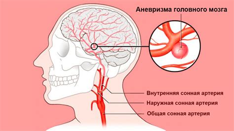 Причины возникновения окклюзии сосудов головного мозга