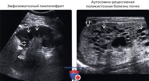 Причины выделяющихся пирамидок в почках и их симптомы