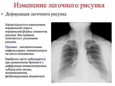 Причины диффузной деформации легочного рисунка