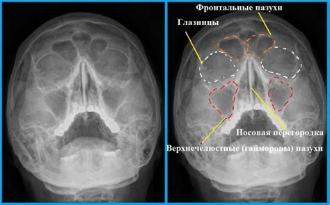 Причины затемнения лобных пазух на рентгене