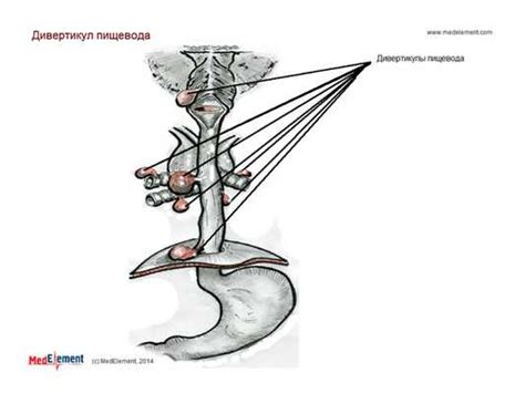 Причины и факторы риска развития дивертикула пищевода